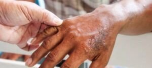 ¿Cómo se contagia la Lepra?