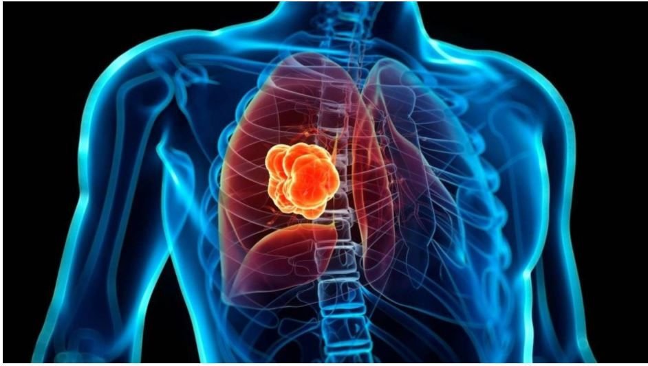 El cáncer de pulmón es la primera causa de muerte a nivel mundial