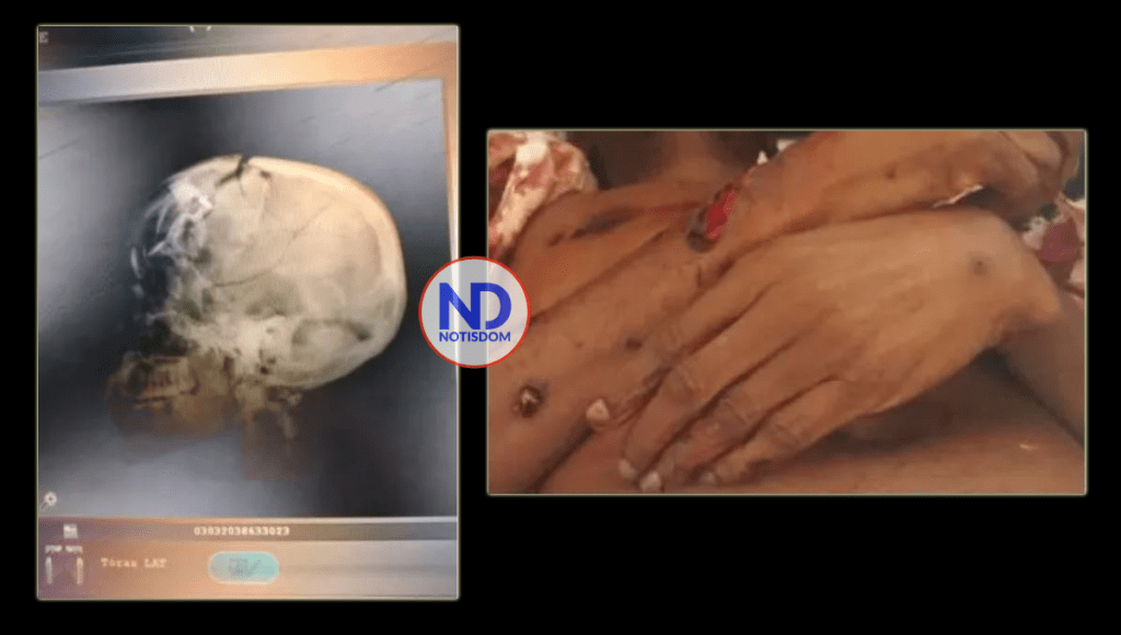 COLLAGE ND Circulan fotos y radiografías del cuerpo de Jovenel Moise tras el magnicidio