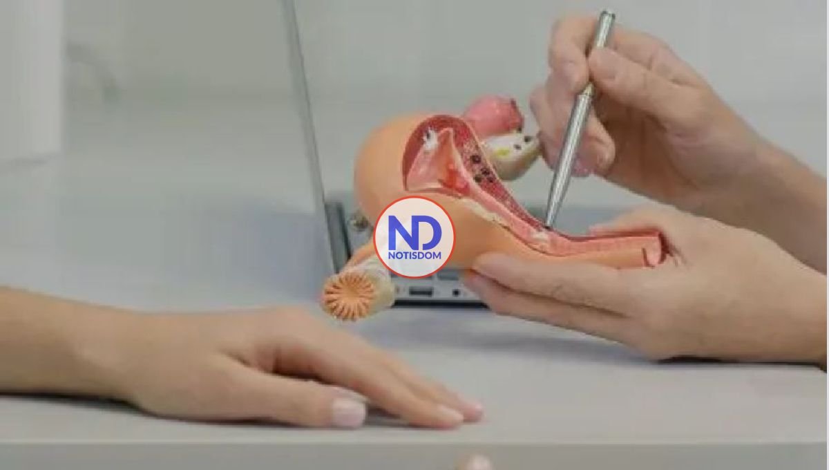El síndrome de ovario poliquístico y su tratamiento