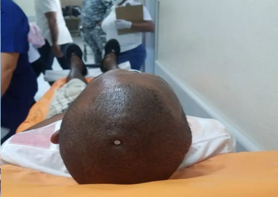 CLAVO 1 Hombre se clava un clavo en su cabeza porque “sentía su cerebro flojo”
