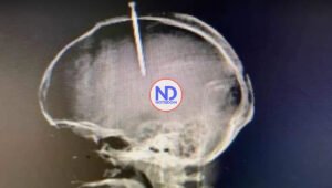 Muere joven que se perforó la cabeza con un clavo porque supuestamente se sentía el cerebro flojo