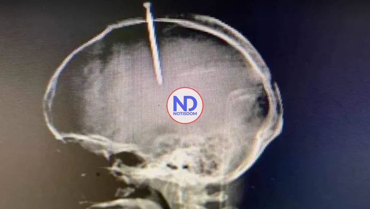 Muere joven que se perforó la cabeza con un clavo porque supuestamente se sentía el cerebro flojo