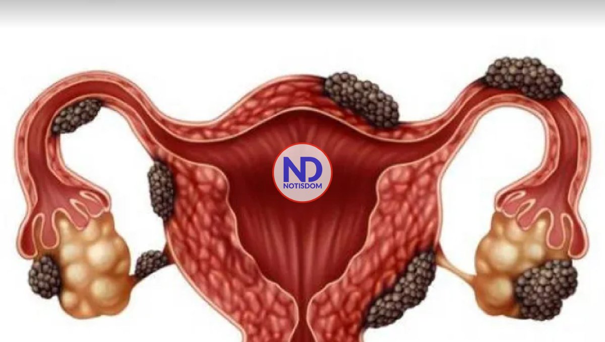 Endometriosis se puede tratar con diferentes tratamientos