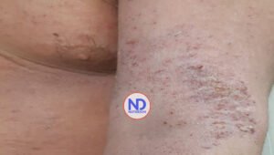La dermatitis atópica es controlable en niños