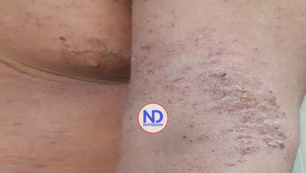 La dermatitis atópica es controlable en niños 2 La dermatitis atópica es controlable en niños
