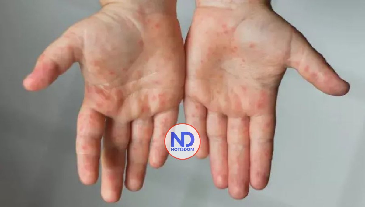 Por qué están comparando la variante ómicron con el sarampión