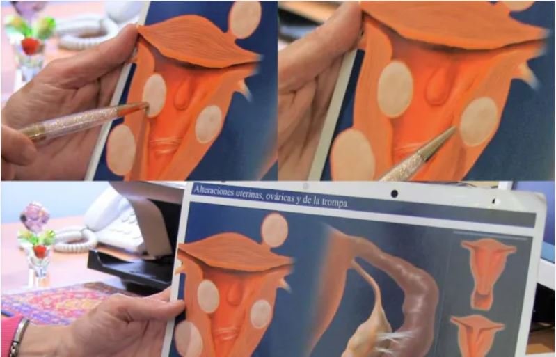 MIOMAS Mioma uterino: qué es y algunos de sus síntomas