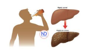 Pacientes cirrosis por alcohol con peores pronósticos de recuperación