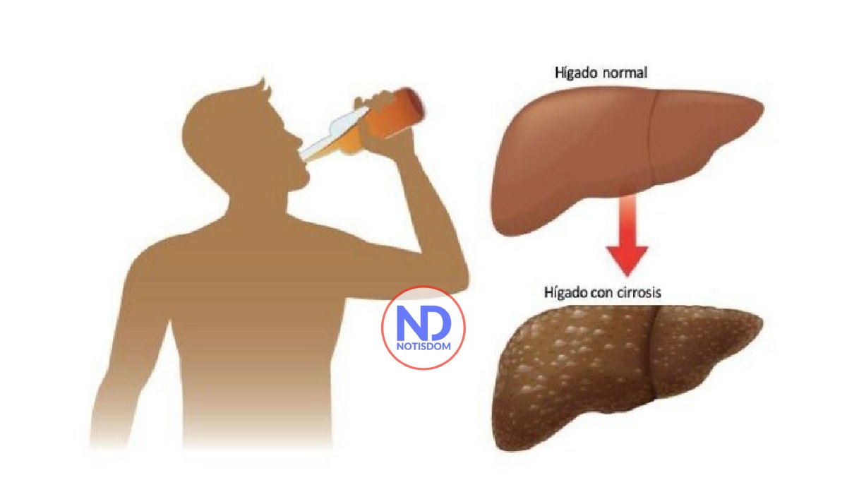 Pacientes cirrosis por alcohol con peores pronósticos de recuperación