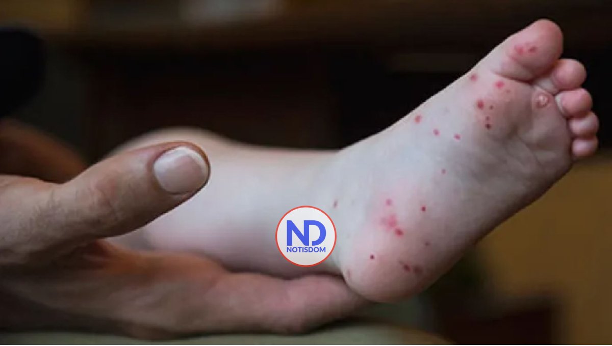 ¿Su hijo presenta lesiones en la piel? puede estar padeciendo «boca, pie y mano»