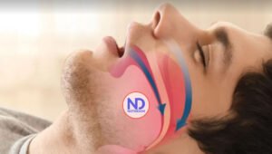 Experta explica cómo identificar cuando se padece apnea del sueño