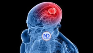 Logran eliminar en animales el tumor cerebral más común