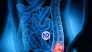 Cirujana oncóloga advierte sobre incidencia del cáncer de colon