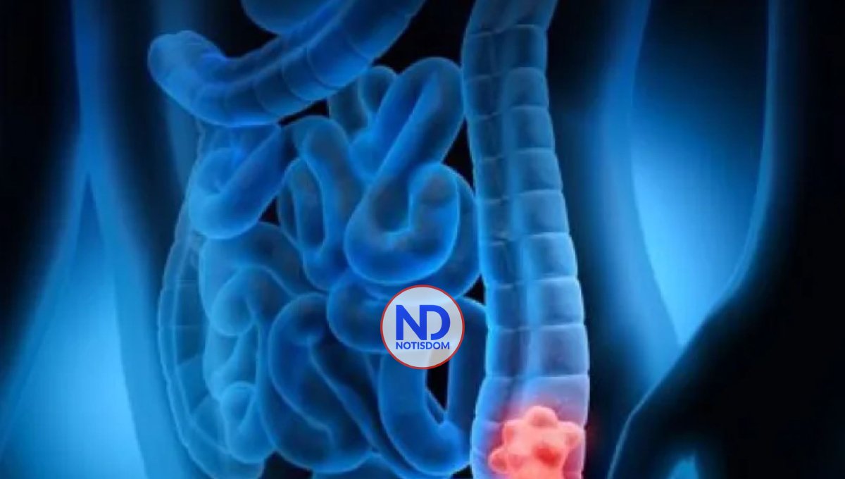 Cirujana oncóloga advierte sobre incidencia del cáncer de colon