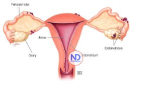 La endometriosis afecta a 1 de cada 10 mujeres en el mundo