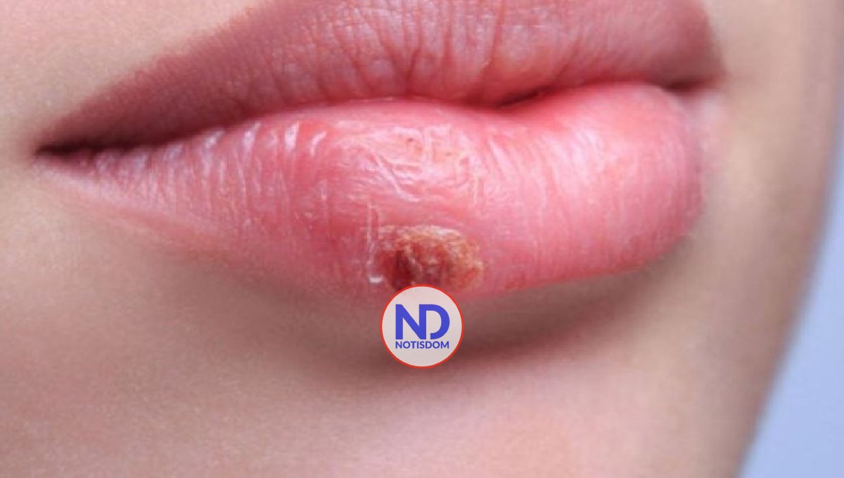 Cómo evitar y tratar la infección del herpes labial