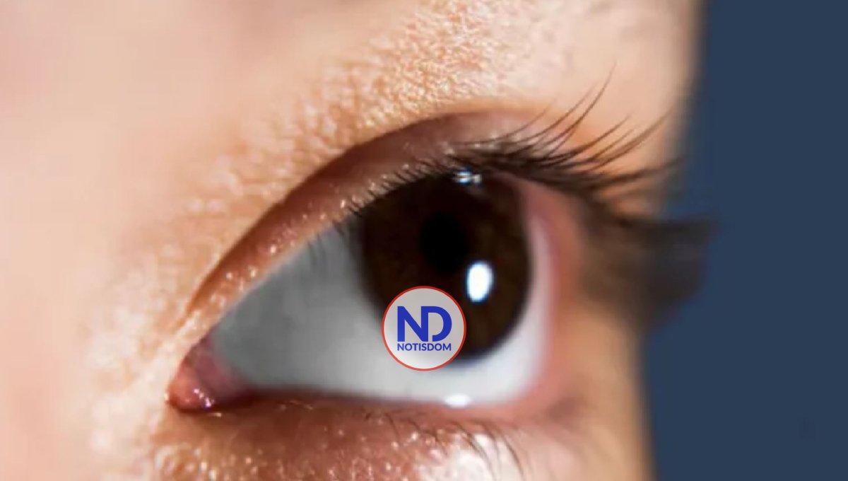 Cuidado con el glaucoma si tienes miopía