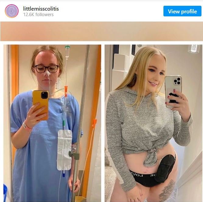 AGREGA Colitis ulcerosa: «Iba al baño hasta 30 veces al día»