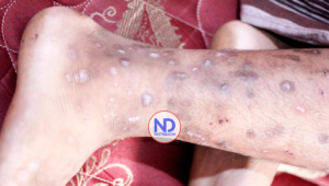 Salud Pública informa que se mantiene alerta ante enfermedad cutánea registrada en Haití