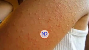 En RD no hay reportes de enfermedad cutánea afecta Haití; activan «sistema de vigilancia Centinela»