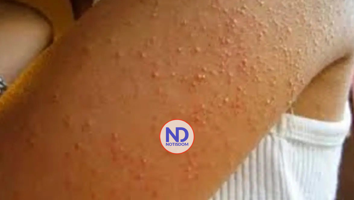 En RD no hay reportes de enfermedad cutánea afecta Haití; activan «sistema de vigilancia Centinela»