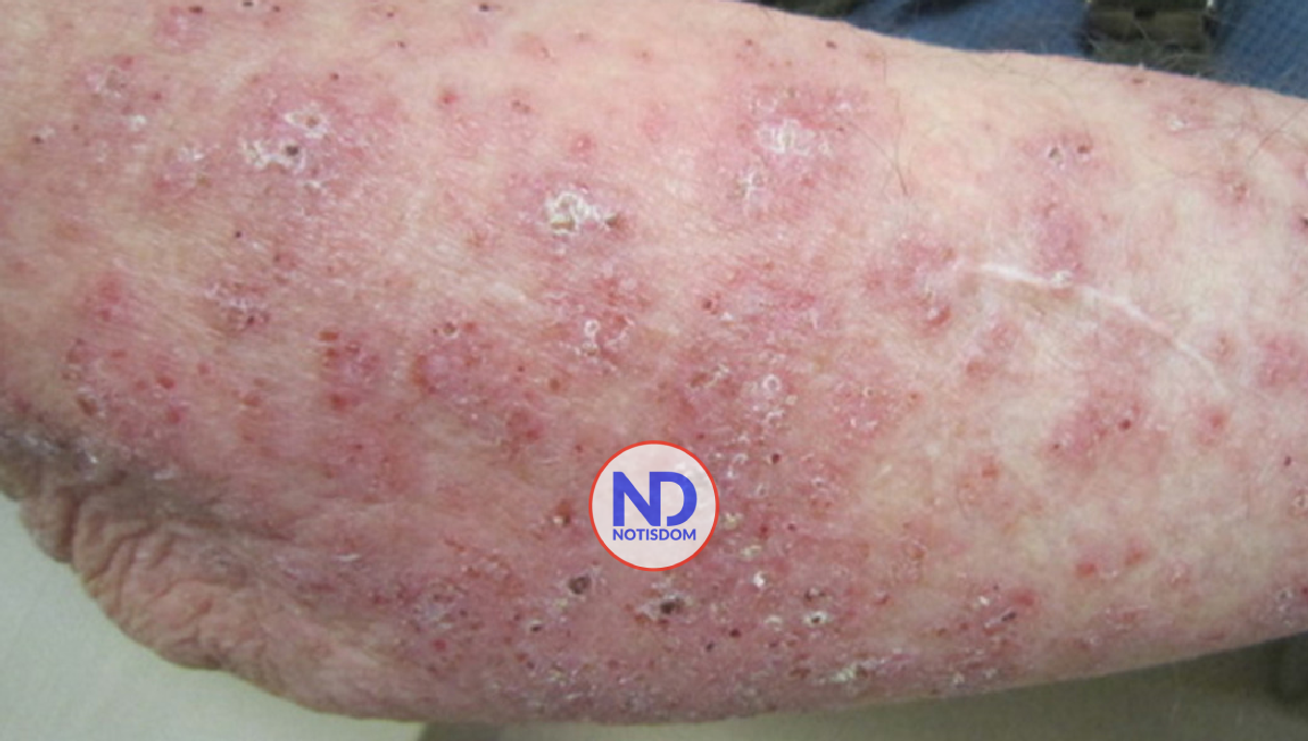 «Si es escabiasis, no hay que temer», afirma Instituto Dermatológico sobre enfermedad en Haití