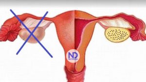¿Puedo quedar embarazada después de una histerectomía y con un solo ovario?