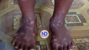 Haití advierte sobre enfermedad de la piel «altamente contagiosa»