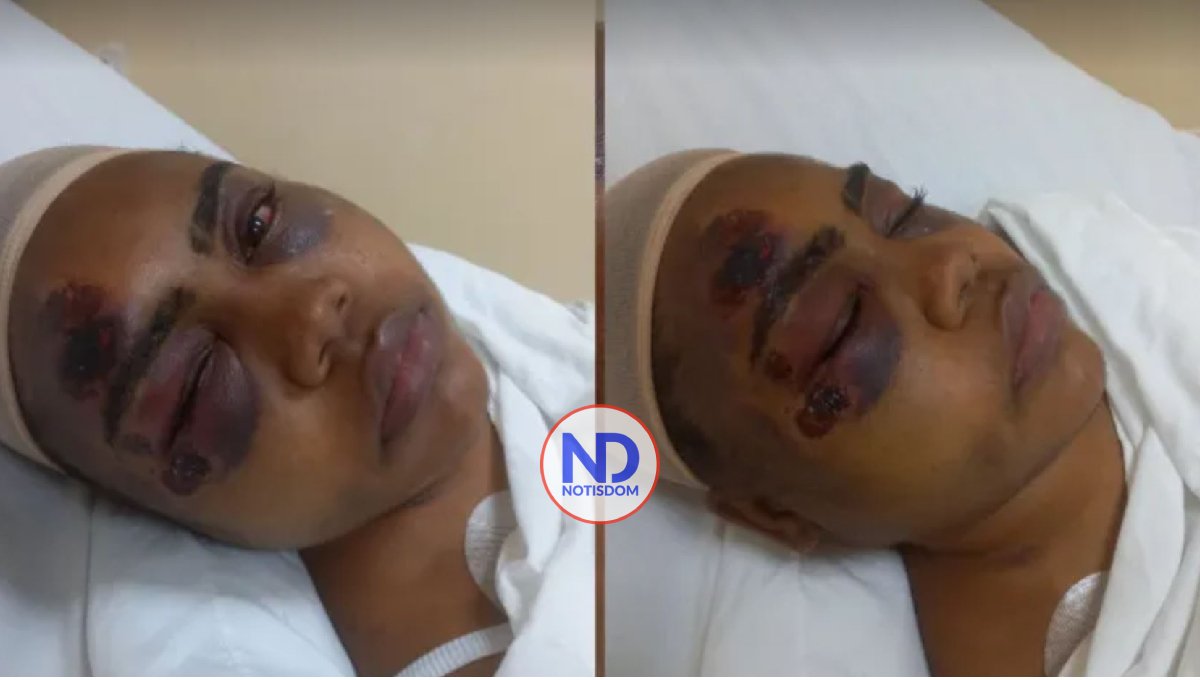 Piden ayuda para tratamiento de joven perdió ojo tras asalto 2 Piden ayuda para tratamiento de joven perdió ojo tras asalto