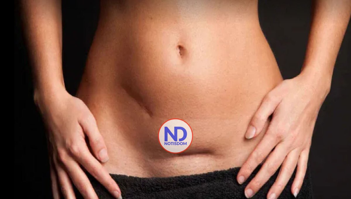 RD con tasa más alta de cesáreas en Latinoamérica 2 RD con tasa más alta de cesáreas en Latinoamérica