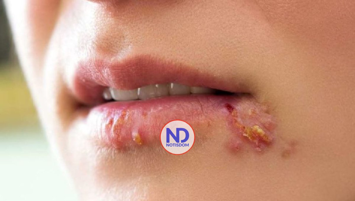 Infección por herpesvirus puede aumentar el riesgo de diabetes