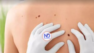 Descubre cómo prevenir el cáncer de piel más grave llamado Melanoma