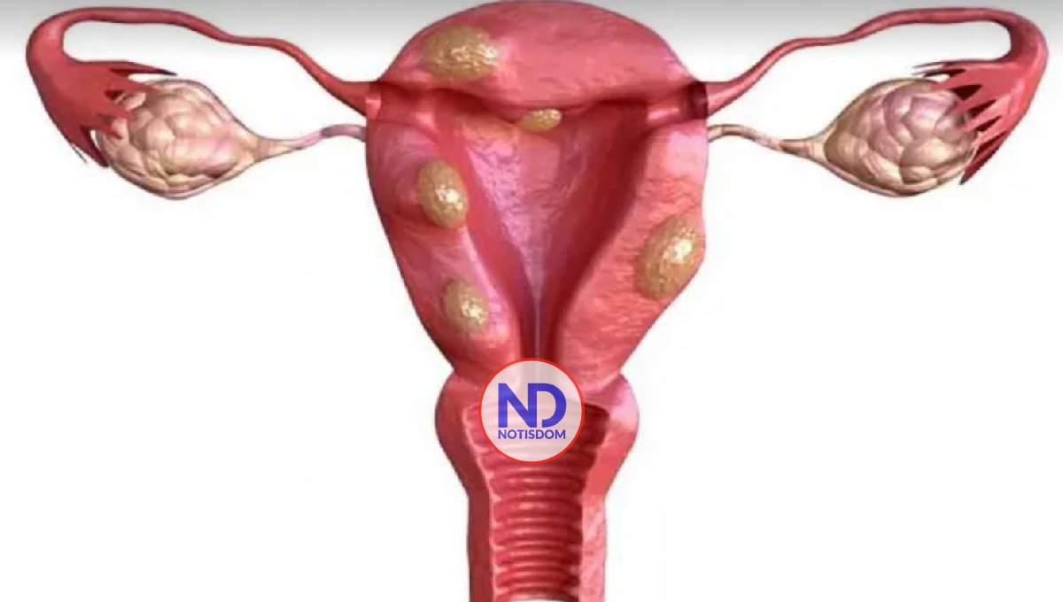 ¿Cuáles posibilidades hay de embarazarse con miomas de siete centímetros en el útero?