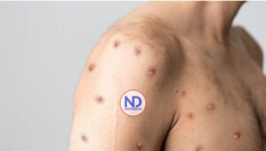 OMS dice brote viruela del mono «todavía puede controlarse»