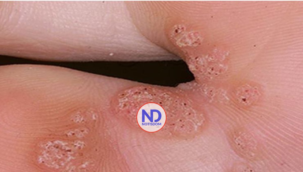 Cómo prevenir el virus del Papiloma Humano (VHP)