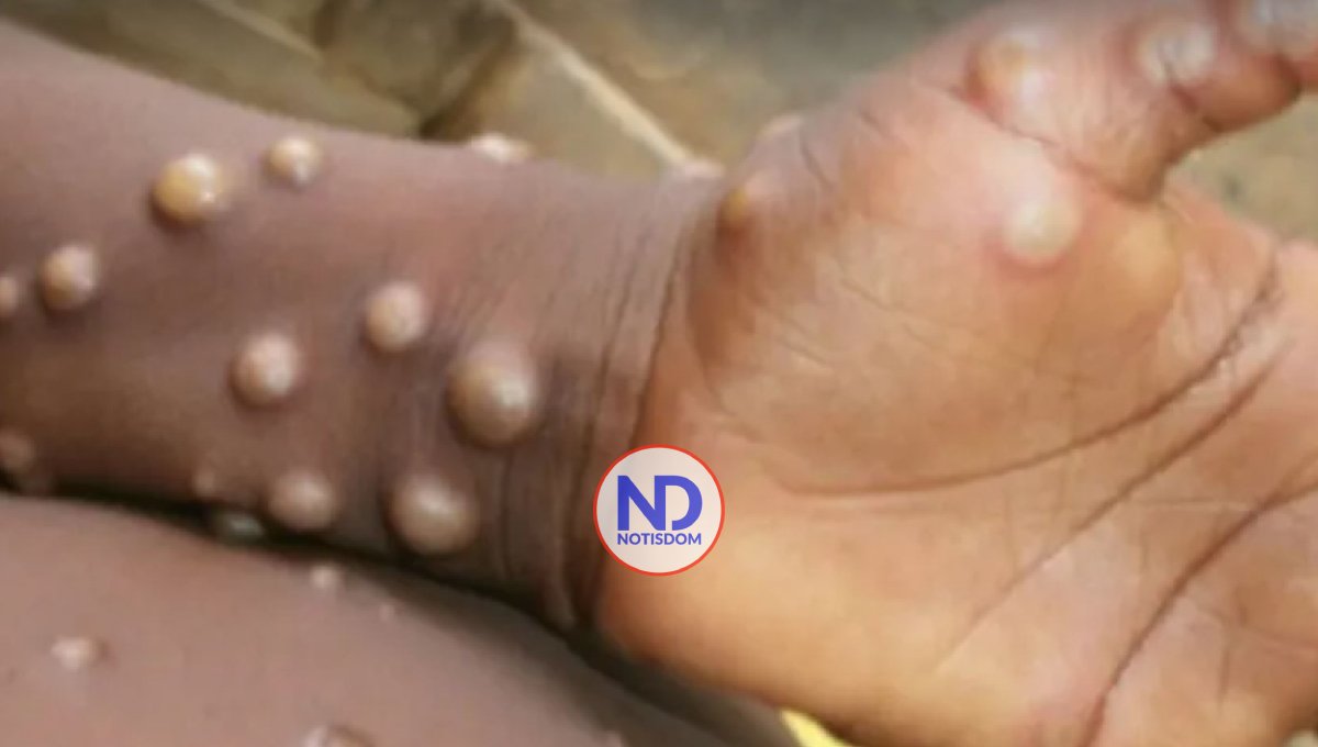 Más de 1300 casos de viruela del mono en 14 países de América