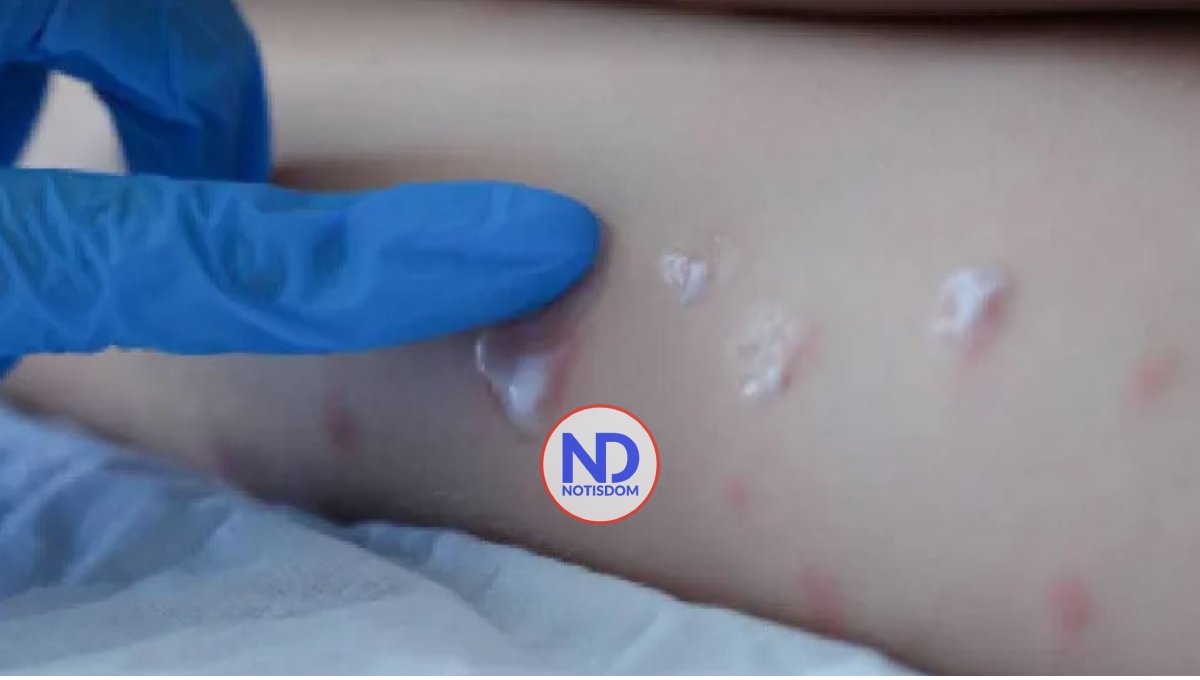 Italia confirma tres casos de viruela del mono 2 Italia confirma tres casos de viruela del mono