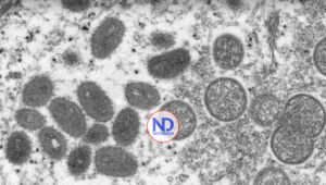 Detectado primer caso de viruela del mono en Suecia