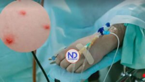 Detectan en Florida un posible caso de viruela del mono