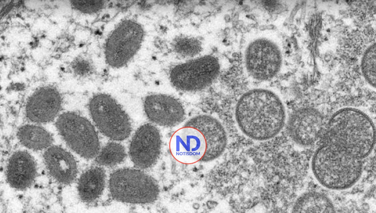 Detectado primer caso de viruela del mono en Suecia