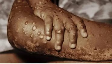 VIRUELA MONO 1 RD emite alerta preventiva por la viruela del mono