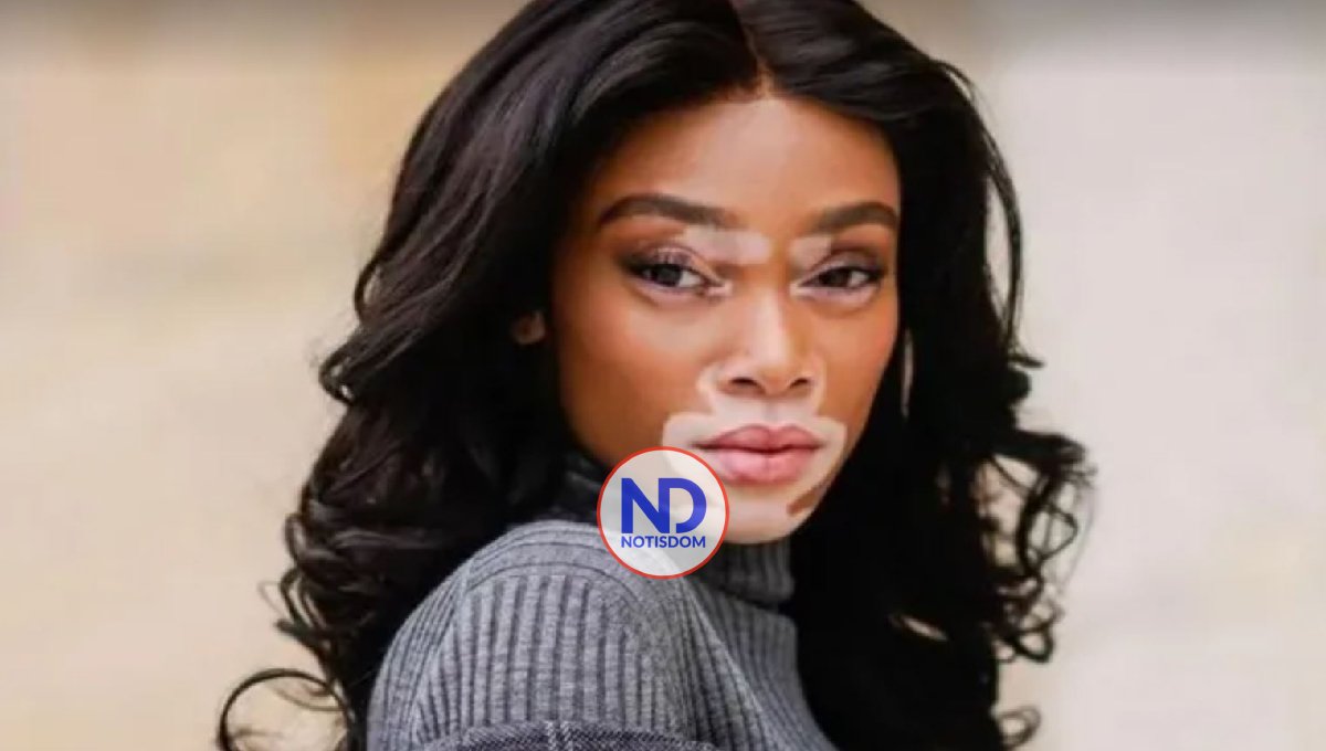 Día Mundial del Vitíligo, todo lo que necesita saber sobre la enfermedad