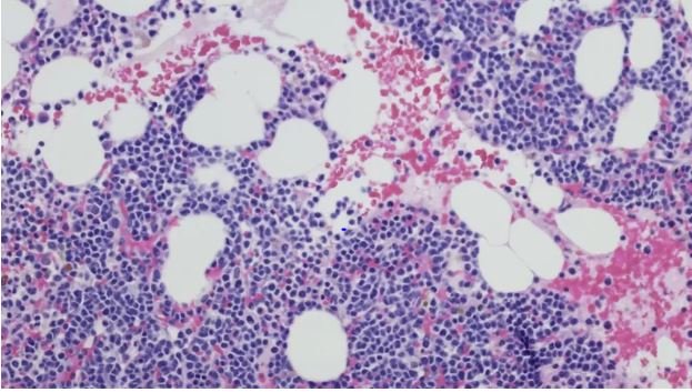 El tipo de cáncer raro que tiene el dolor de espalda como principal síntoma 4 EL MIELOMA El tipo de cáncer raro que tiene el dolor de espalda como principal síntoma