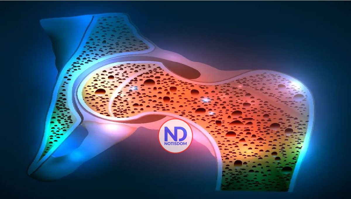 Osteoporosis puede duplique en América Latina para 2050 2 Osteoporosis puede duplique en América Latina para 2050