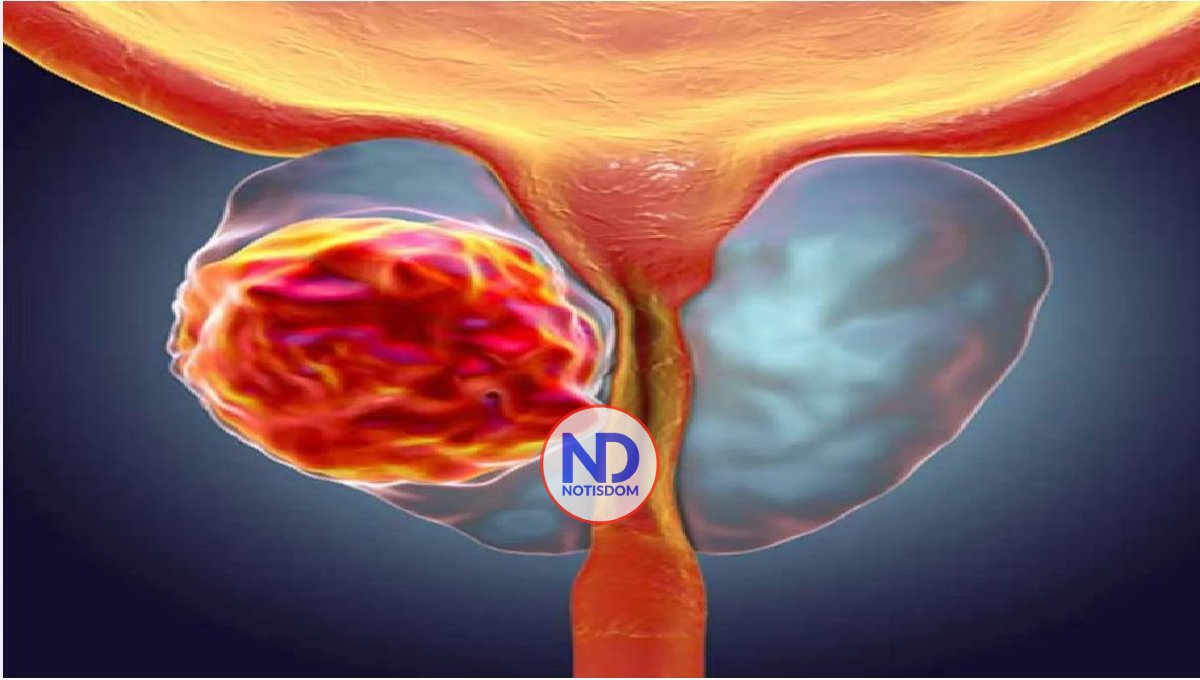 ¡Chequéate! Conocer factores de riesgo, clave detección cáncer próstata