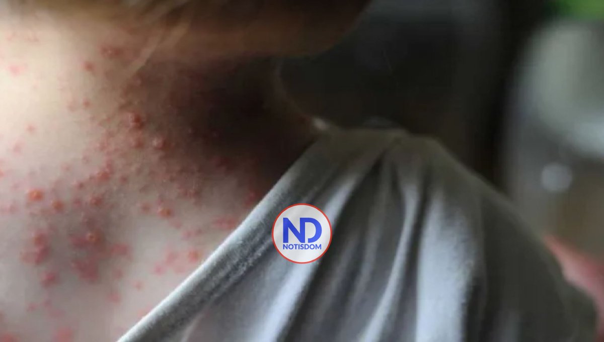 OMS decide que viruela del mono no es una emergencia sanitaria internacional