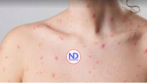 Suben a 21 los casos de viruela del mono en Estados Unidos