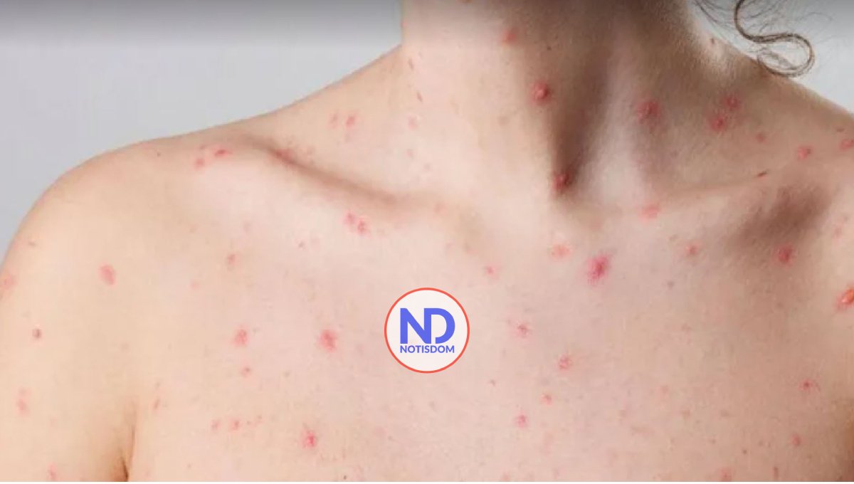 Suben a 21 los casos de viruela del mono en Estados Unidos