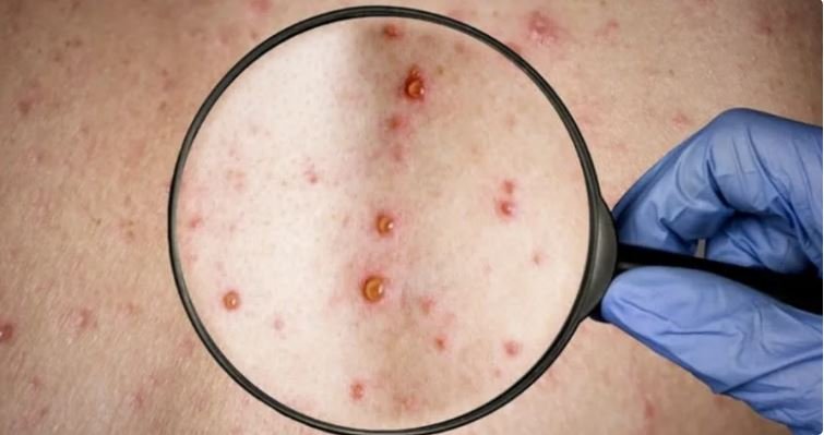 Confirman un primer caso de viruela del mono en el Ejército de EEUU